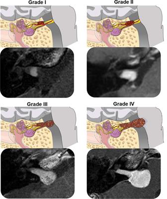 Sporadic Vestibular Schwannoma Size and Location Do not Correlate With the Severity of Hearing Loss at Initial Presentation